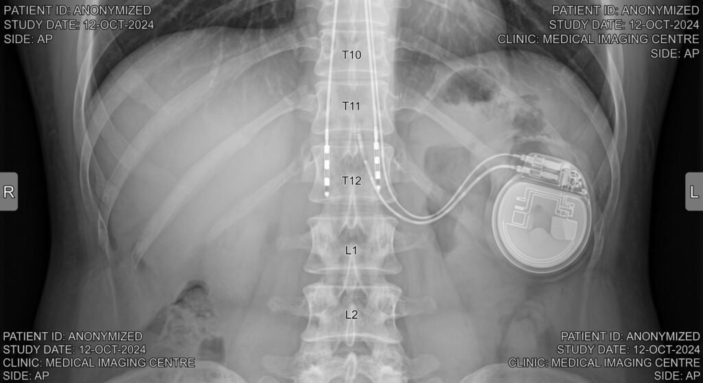Medical X-ray showing an anonymized spinal cord stimulator pulse generator and leads implanted along the thoracic spine